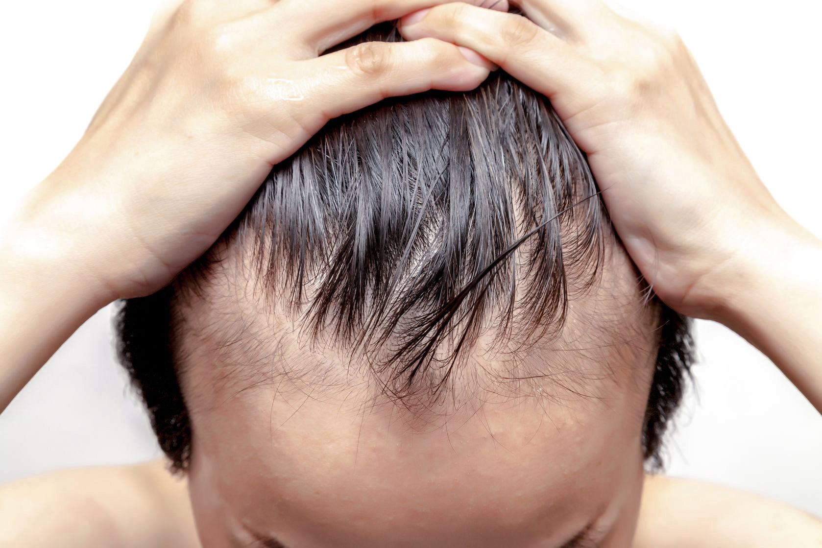 The Truth About Balding (And What You Can Do About it)